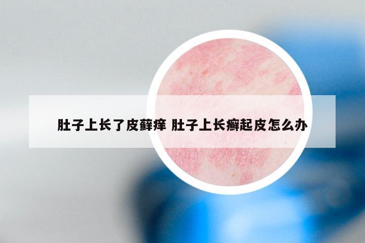 肚子上长了皮藓痒 肚子上长癣起皮怎么办