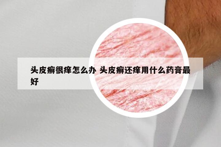 头皮癣很痒怎么办 头皮癣还痒用什么药膏最好