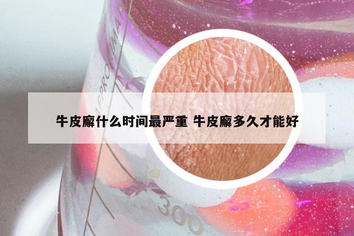 牛皮廨什么时间最严重 牛皮廨多久才能好