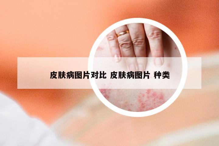 皮肤病图片对比 皮肤病图片 种类
