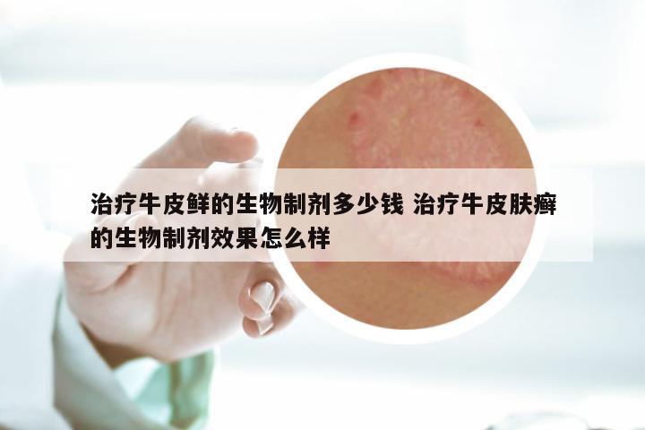 治疗牛皮鲜的生物制剂多少钱 治疗牛皮肤癣的生物制剂效果怎么样