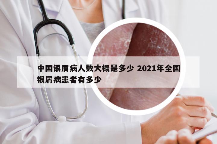 中国银屑病人数大概是多少 2021年全国银屑病患者有多少