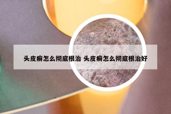 头皮癣怎么彻底根治 头皮癣怎么彻底根治好