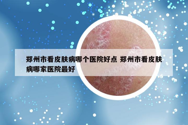 郑州市看皮肤病哪个医院好点 郑州市看皮肤病哪家医院最好