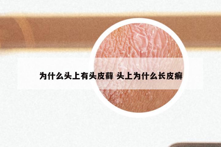 为什么头上有头皮藓 头上为什么长皮癣