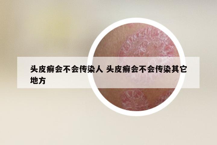 头皮癣会不会传染人 头皮癣会不会传染其它地方