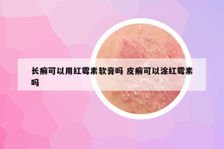 长癣可以用红霉素软膏吗 皮癣可以涂红霉素吗