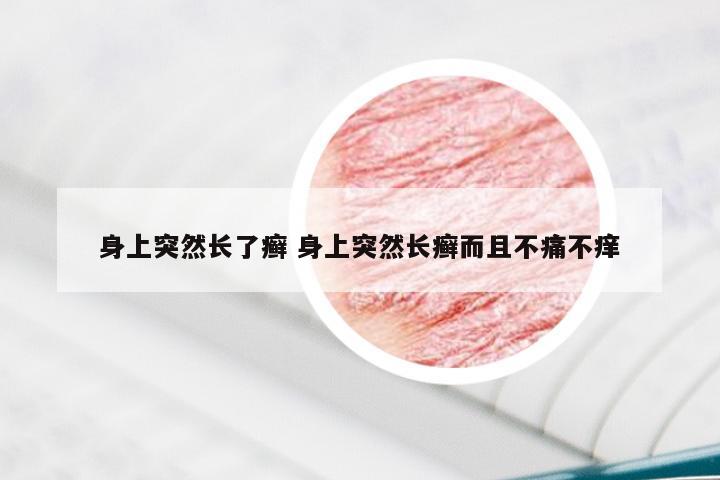 身上突然长了癣 身上突然长癣而且不痛不痒