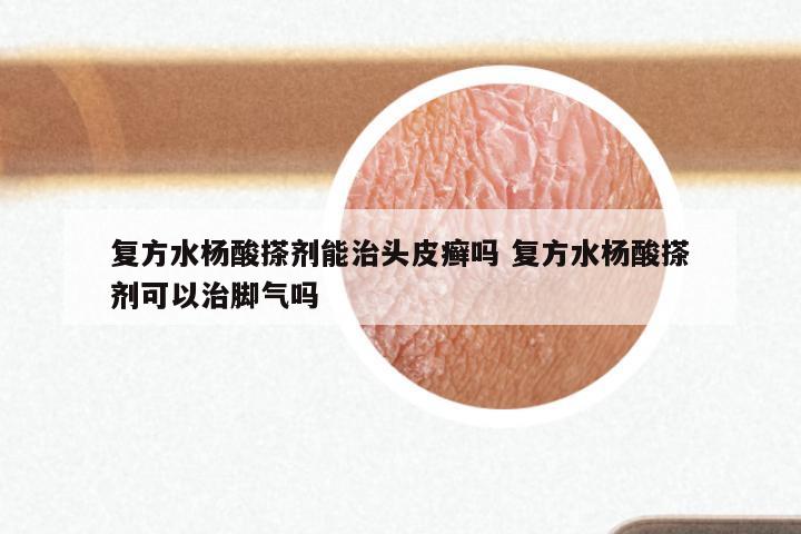 复方水杨酸搽剂能治头皮癣吗 复方水杨酸搽剂可以治脚气吗