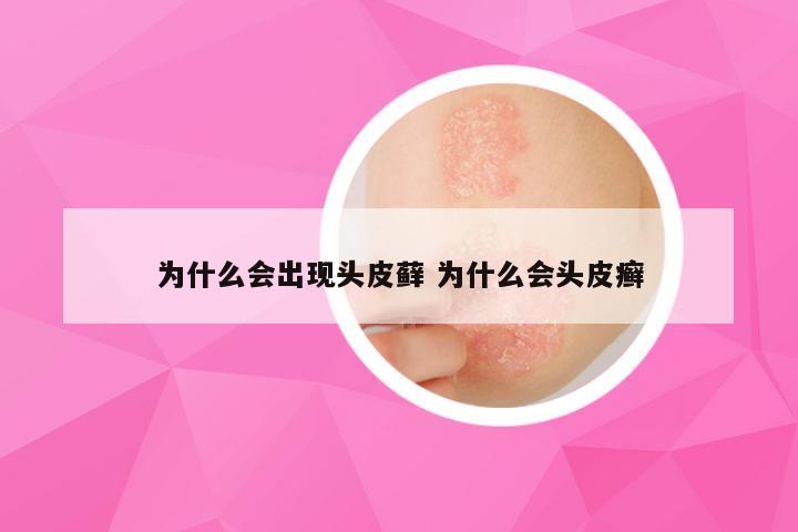 为什么会出现头皮藓 为什么会头皮癣