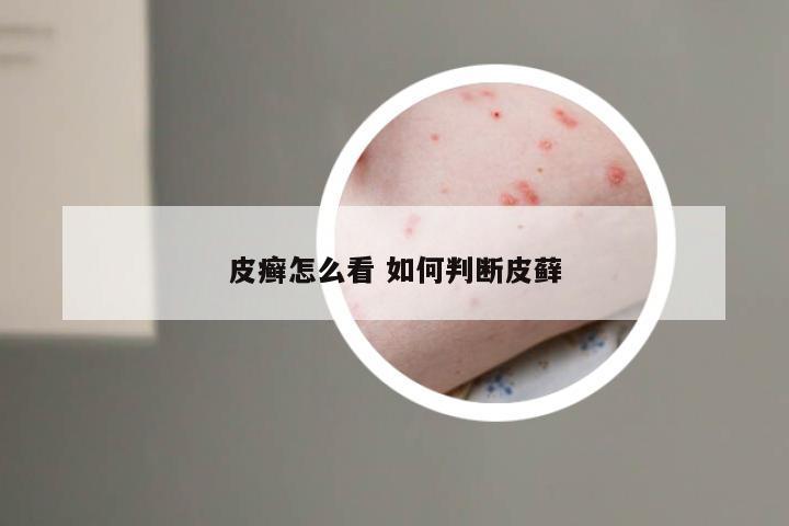 皮癣怎么看 如何判断皮藓