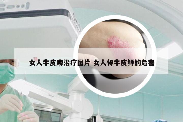 女人牛皮廨治疗图片 女人得牛皮鲜的危害