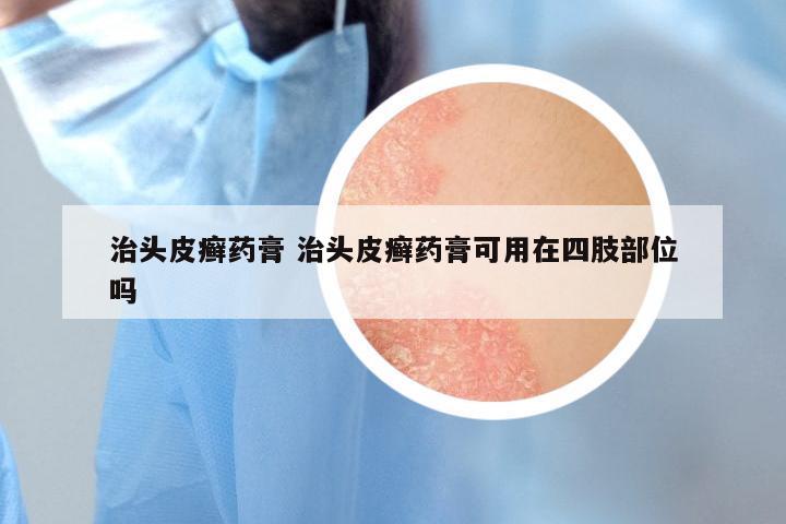 治头皮癣药膏 治头皮癣药膏可用在四肢部位吗