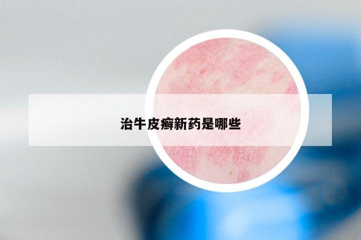 治牛皮癣新药是哪些
