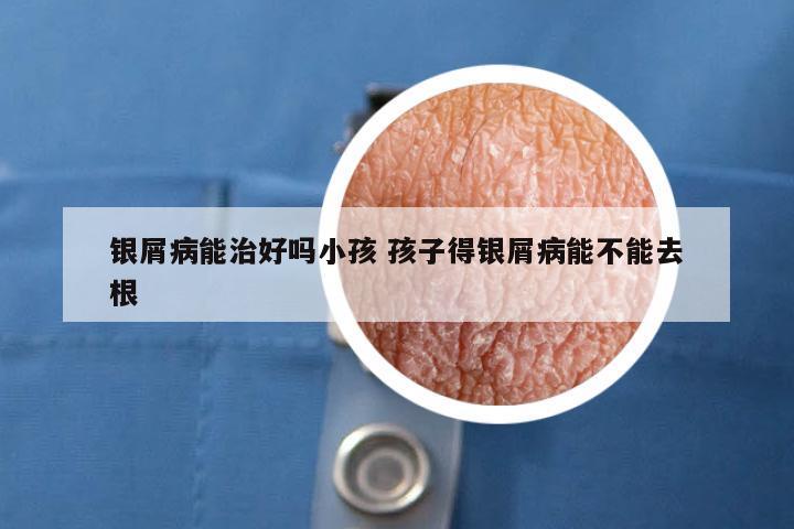 银屑病能治好吗小孩 孩子得银屑病能不能去根