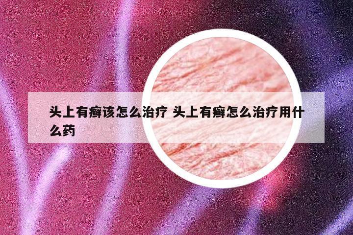 头上有癣该怎么治疗 头上有癣怎么治疗用什么药