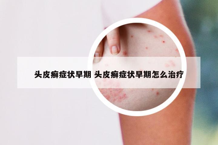 头皮癣症状早期 头皮癣症状早期怎么治疗