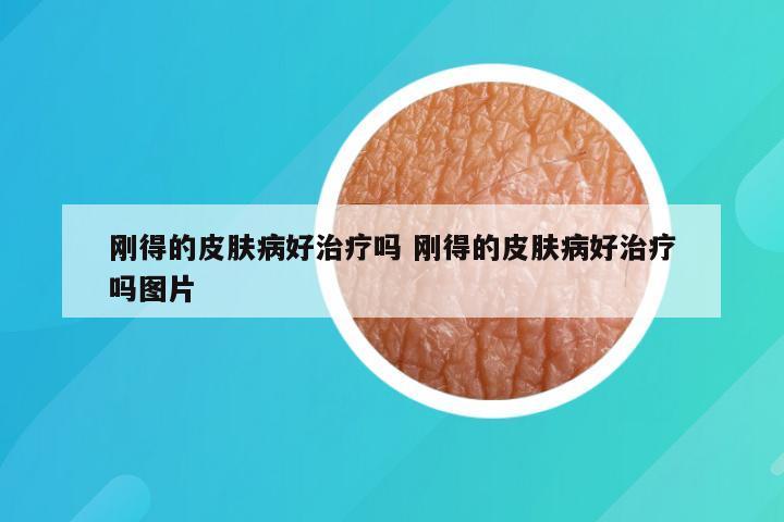 刚得的皮肤病好治疗吗 刚得的皮肤病好治疗吗图片