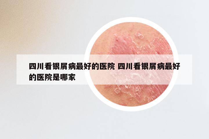 四川看银屑病最好的医院 四川看银屑病最好的医院是哪家