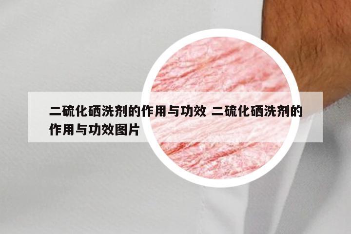 二硫化硒洗剂的作用与功效 二硫化硒洗剂的作用与功效图片