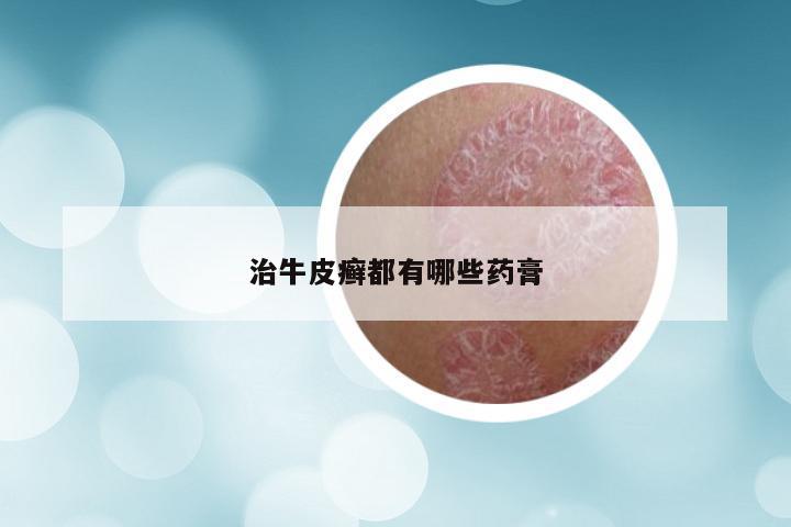 治牛皮癣都有哪些药膏