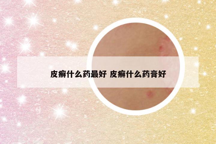 皮癣什么药最好 皮癣什么药膏好