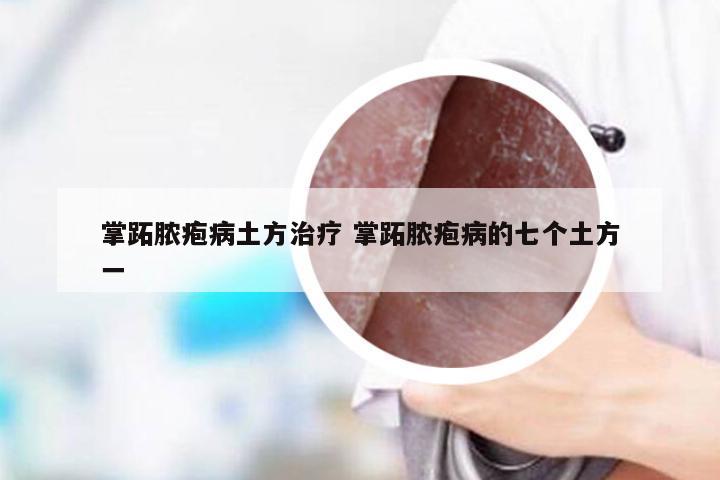 掌跖脓疱病土方治疗 掌跖脓疱病的七个土方一