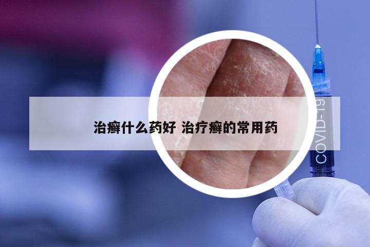 治癣什么药好 治疗癣的常用药