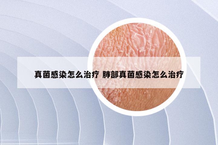 真菌感染怎么治疗 肺部真菌感染怎么治疗