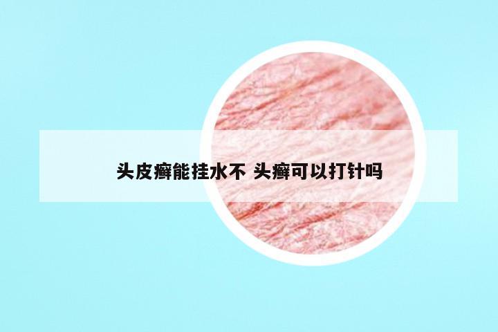 头皮癣能挂水不 头癣可以打针吗