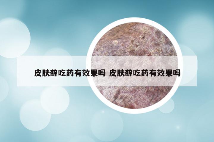 皮肤藓吃药有效果吗 皮肤藓吃药有效果吗