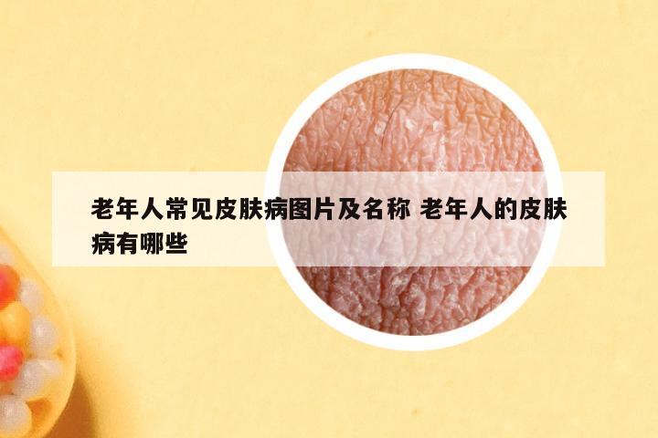 老年人常见皮肤病图片及名称 老年人的皮肤病有哪些