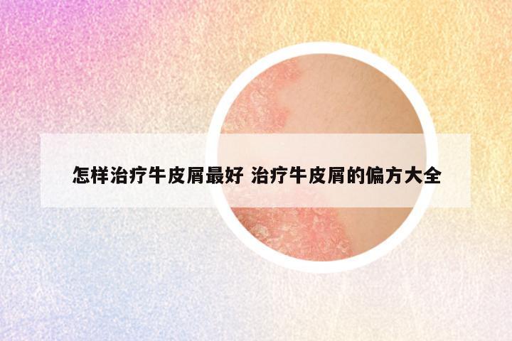 怎样治疗牛皮屑最好 治疗牛皮屑的偏方大全