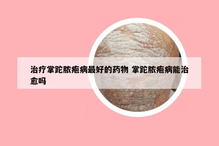 治疗掌跎脓疱病最好的药物 掌跎脓疱病能治愈吗