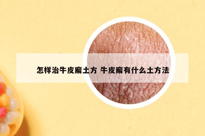 怎样治牛皮廨土方 牛皮廨有什么土方法