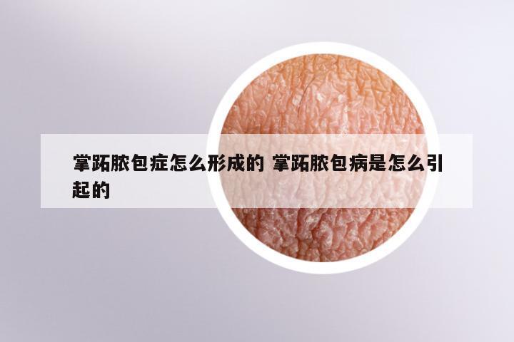 掌跖脓包症怎么形成的 掌跖脓包病是怎么引起的