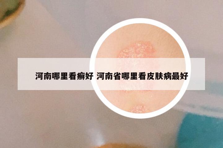 河南哪里看癣好 河南省哪里看皮肤病最好
