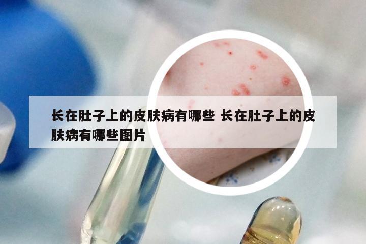 长在肚子上的皮肤病有哪些 长在肚子上的皮肤病有哪些图片