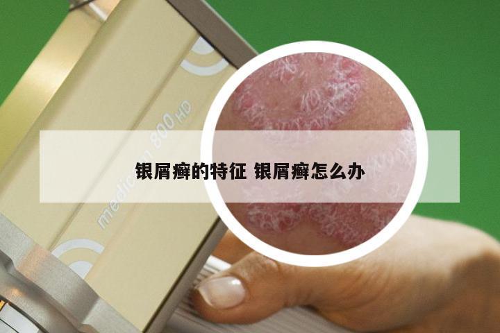 银屑癣的特征 银屑癣怎么办