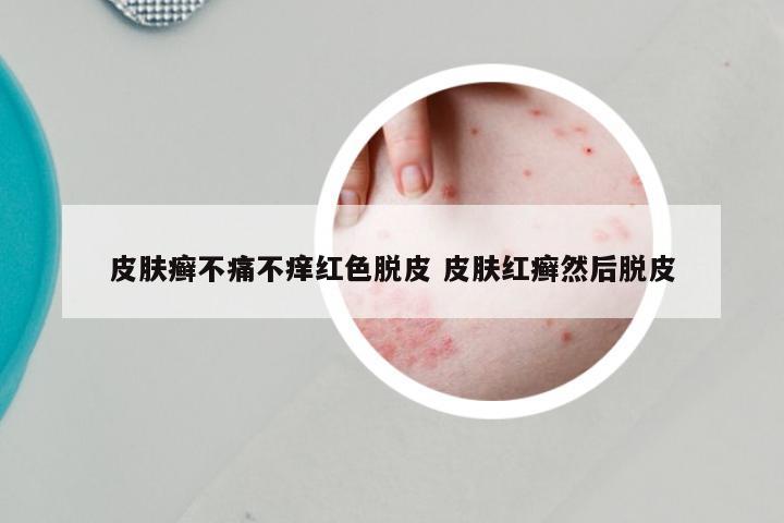 皮肤癣不痛不痒红色脱皮 皮肤红癣然后脱皮