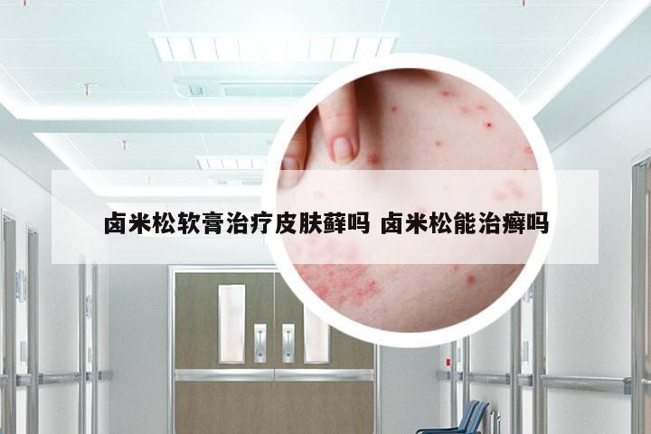卤米松软膏治疗皮肤藓吗 卤米松能治癣吗