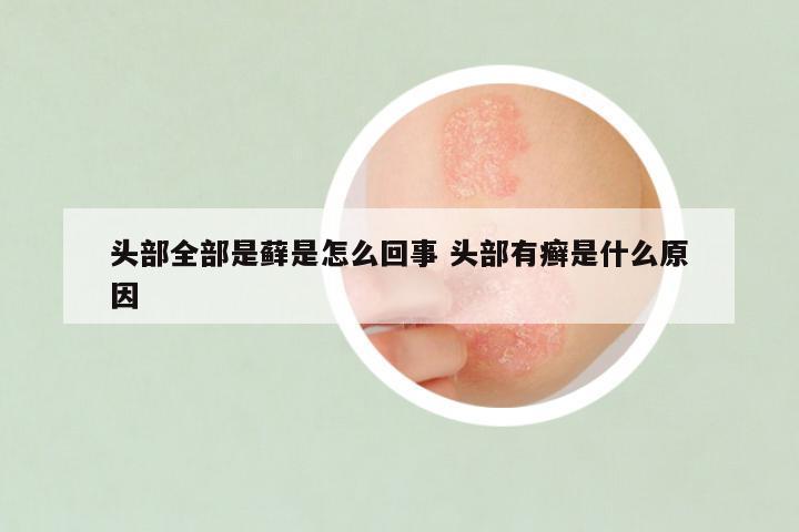 头部全部是藓是怎么回事 头部有癣是什么原因