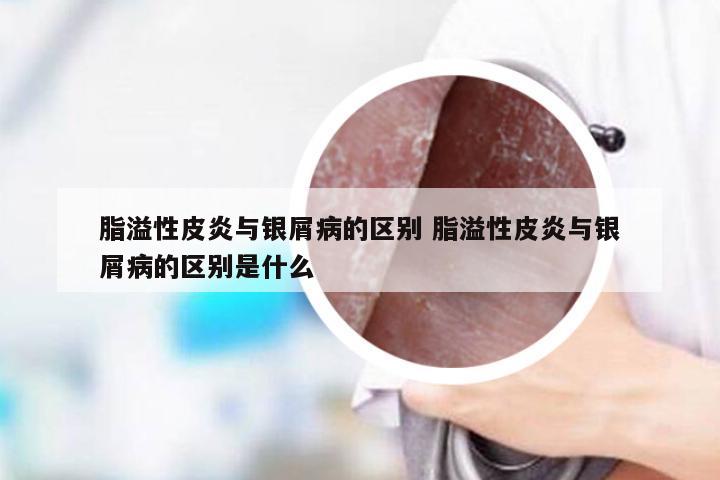 脂溢性皮炎与银屑病的区别 脂溢性皮炎与银屑病的区别是什么