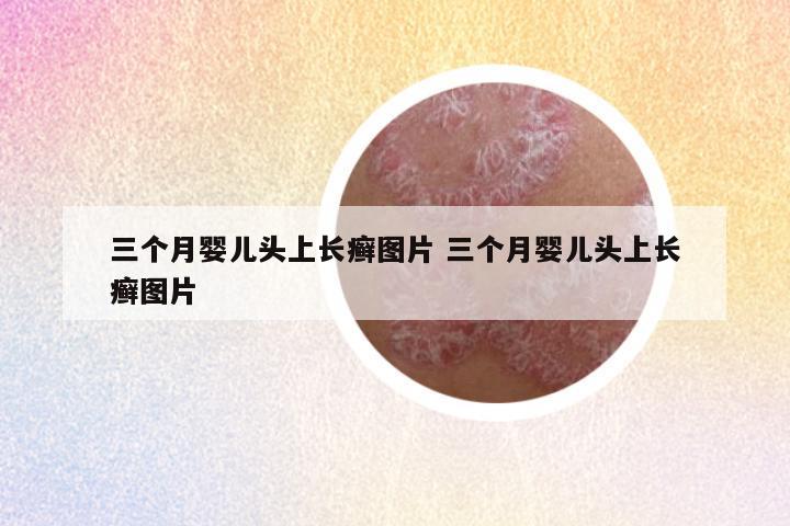 三个月婴儿头上长癣图片 三个月婴儿头上长癣图片