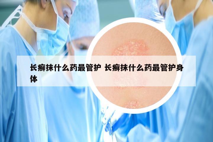 长癣抹什么药最管护 长癣抹什么药最管护身体