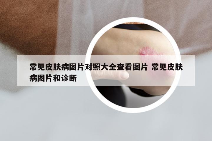常见皮肤病图片对照大全查看图片 常见皮肤病图片和诊断