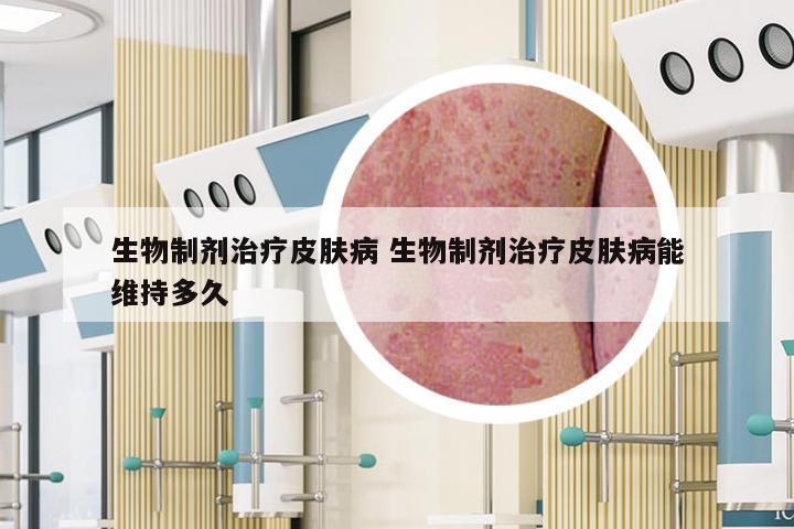 生物制剂治疗皮肤病 生物制剂治疗皮肤病能维持多久