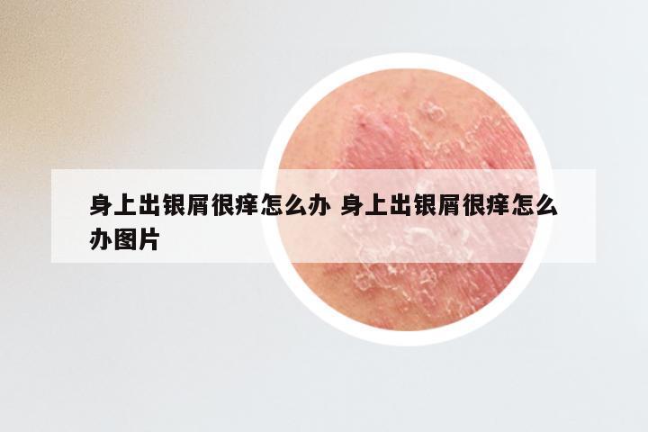 身上出银屑很痒怎么办 身上出银屑很痒怎么办图片