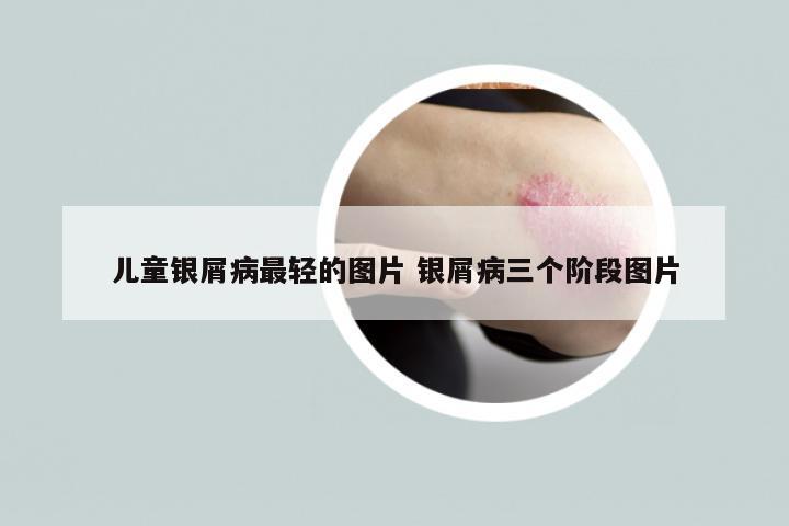 儿童银屑病最轻的图片 银屑病三个阶段图片