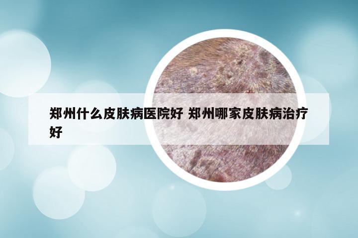 郑州什么皮肤病医院好 郑州哪家皮肤病治疗好
